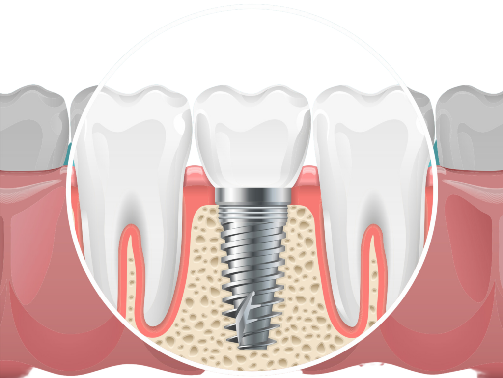 dental implants san antonio tx
