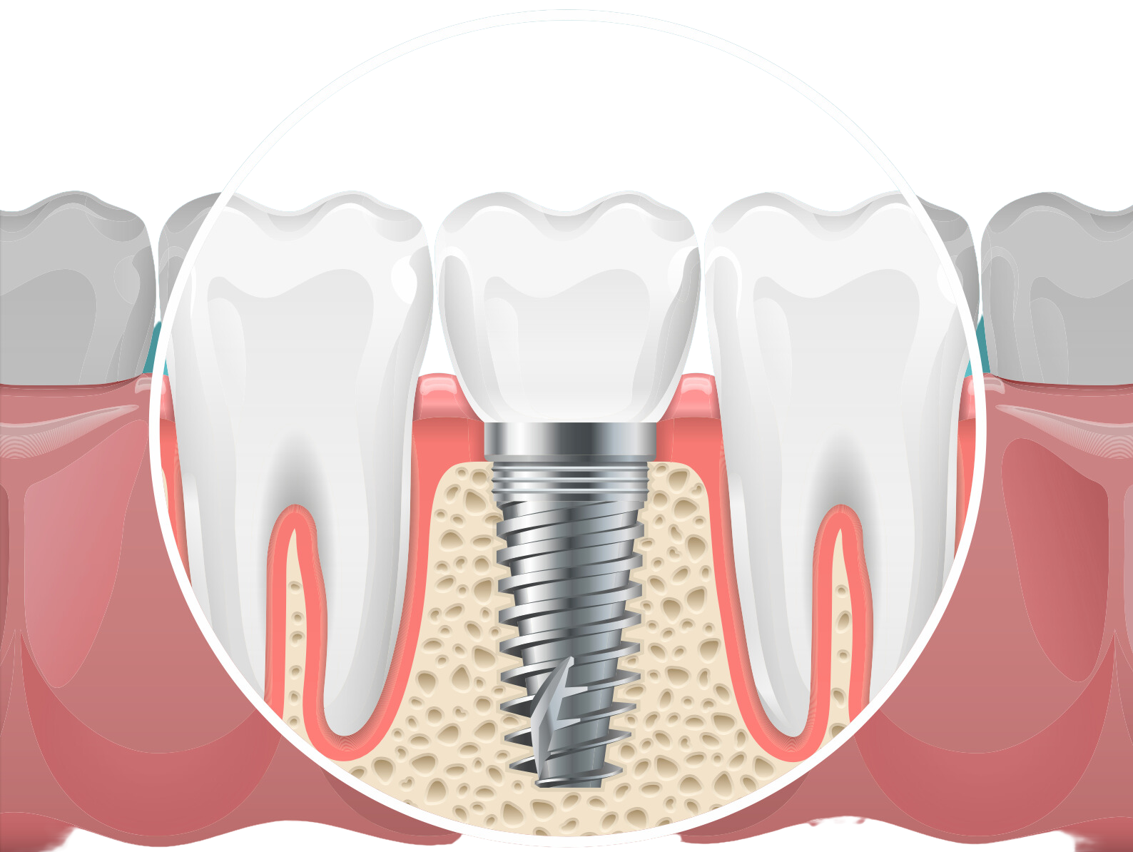 Best Dental Implants in San Antonio, TX