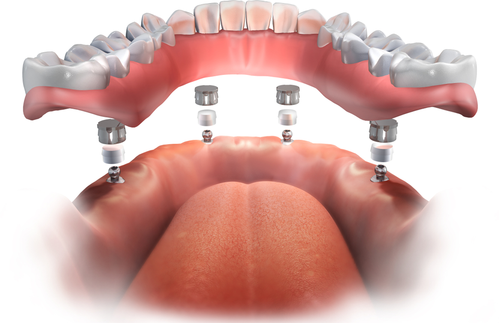 Implant Supported Dentures San Antonio TX