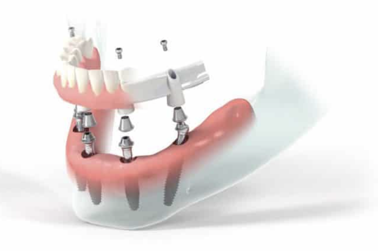 All-on-4 Dental Implants San Antonio TX