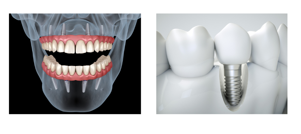 all on 4 dental implants san antonio tx