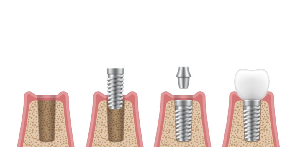 dental implant procedure san antonio tx