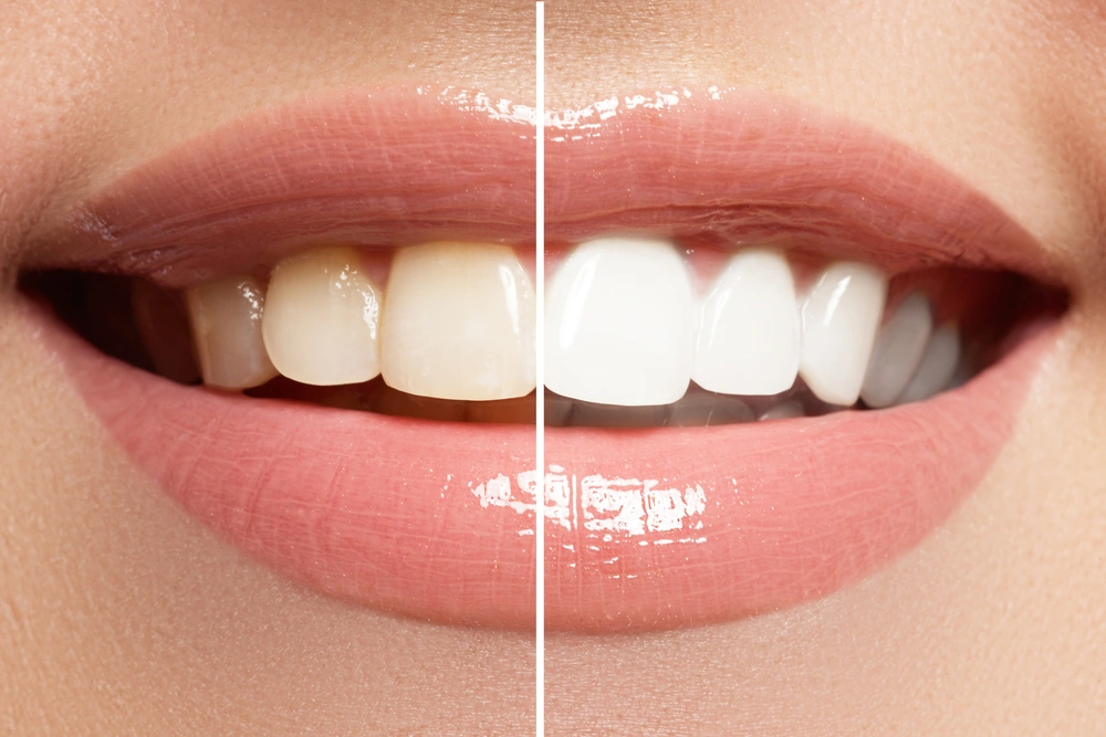 Cosmetic Dentistry Whitening Cost in San Antonio TX Fountain of Youth